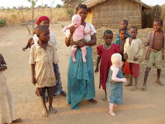 La emergencia silenciosa de los albinos en Tanzania