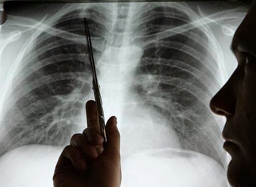 7 Señales de advertencia de cáncer de pulmón que no debes ignorar