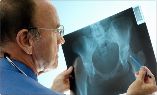 Cosas que debes saber sobre la osteoporosis