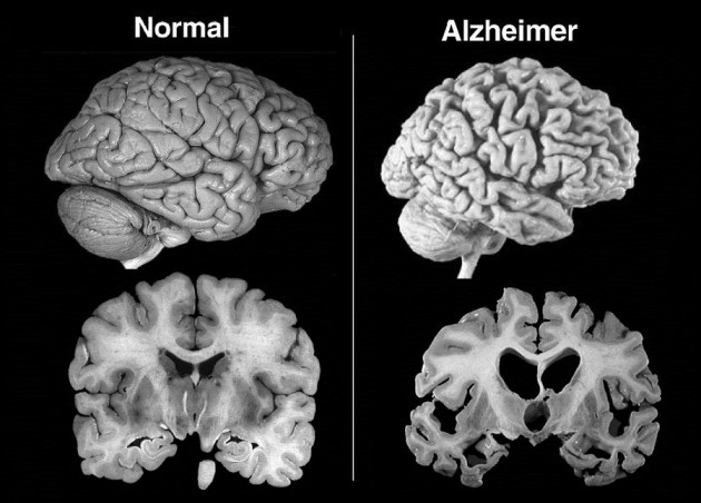 10 señales que podrían indicar que tienes Alzheimer