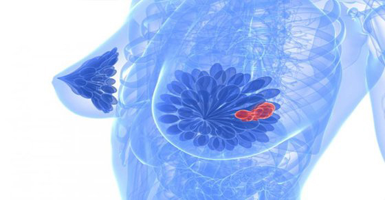 Sorprendentes causas del cáncer de pecho