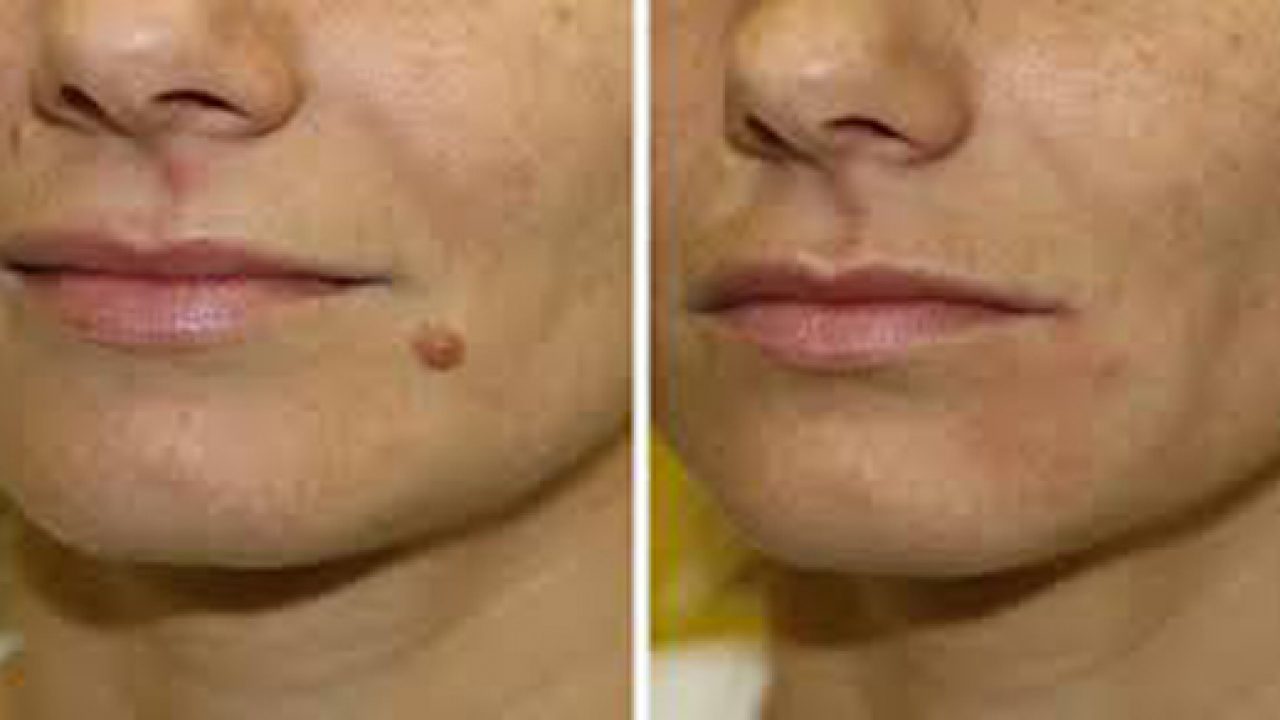 Quitar lunares de forma natural