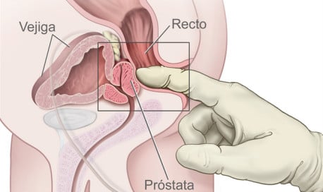 Incontinencia Anal: ¿Por qué ocurre? ¿Qué hacer?