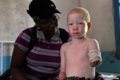 Albinismo: El conmovedor caso de la modelo Thando Hopa