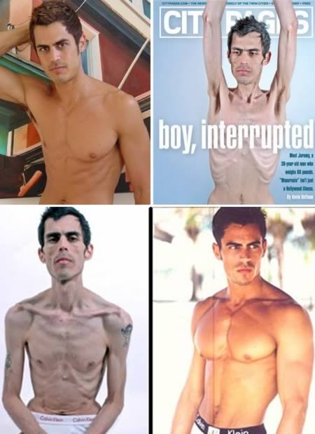 Las 10 historias sobre la anorexia que más conmocionaron a la opinión pública