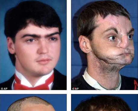La increíble transformación de un hombre que, tras sufrir un disparo, recibió la más impresionante cirugía plástica