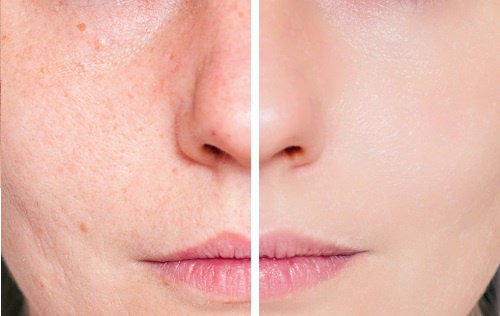 Como combatir las cicatricez del acné en forma eficiente y 100% natural