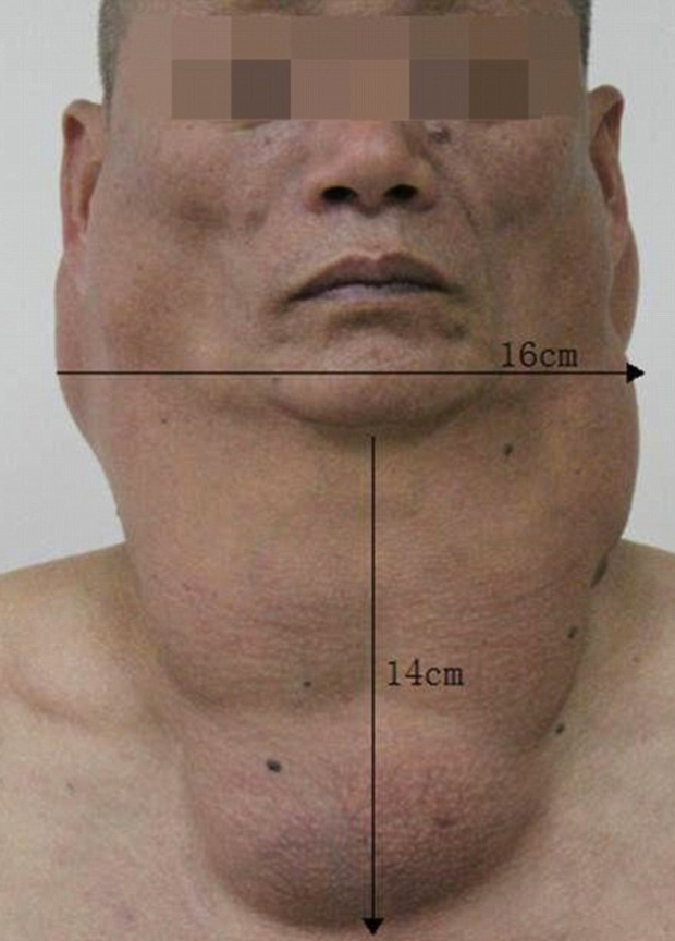 Este hombre desarrolló enormes depósitos de grasa en la garganta ¡La razón es impactante!