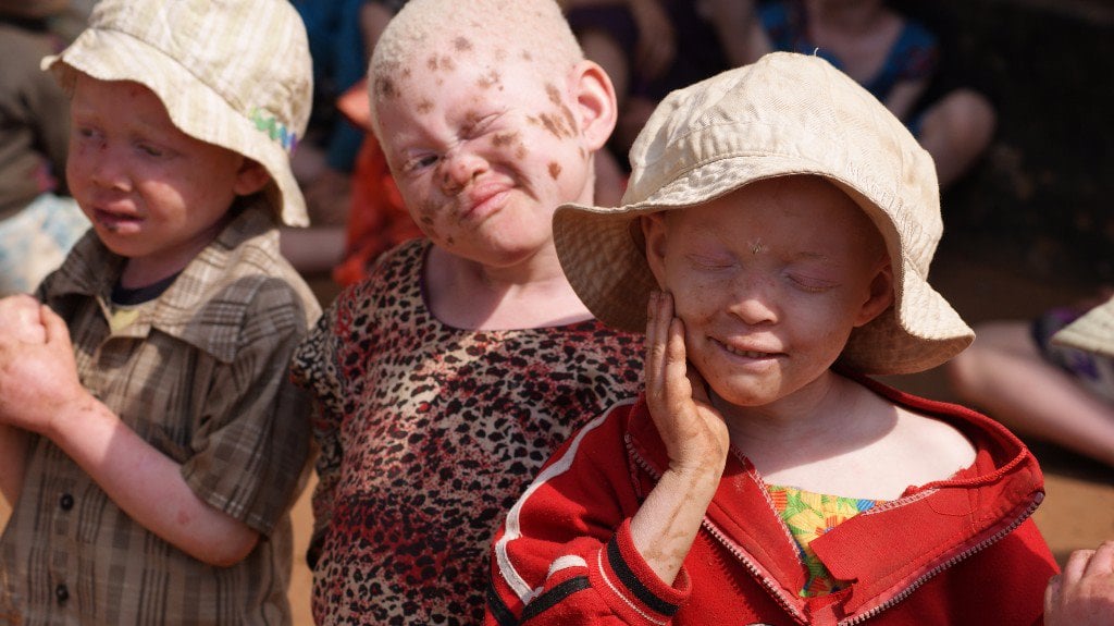 La cacería de niños albinos en Tanzania