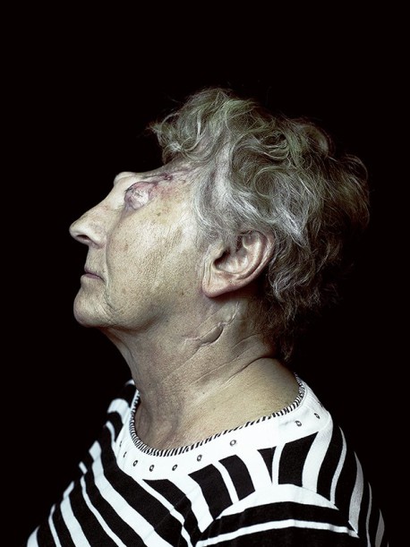 Retratos de pacientes sometidos a reconstrucción facial