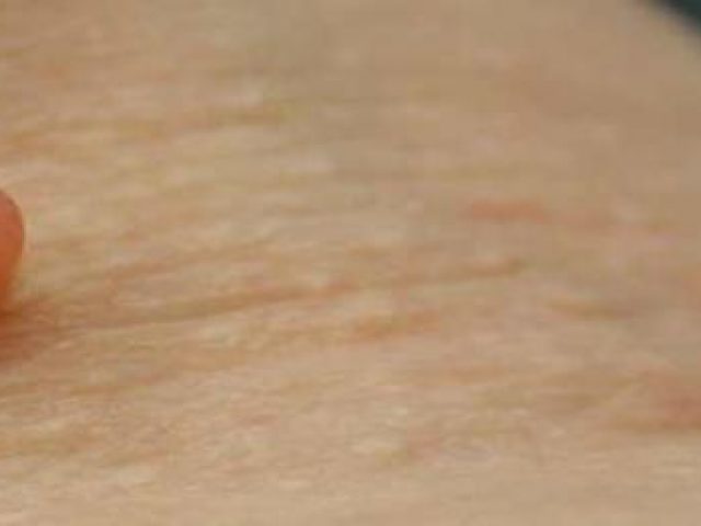 como quitar verrugas con hilo dental