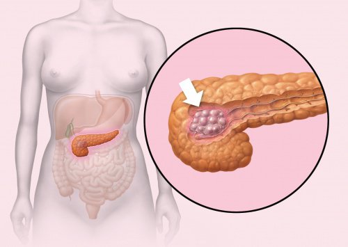 5 señales que pueden indicar que padeces cáncer de páncreas sin saberlo