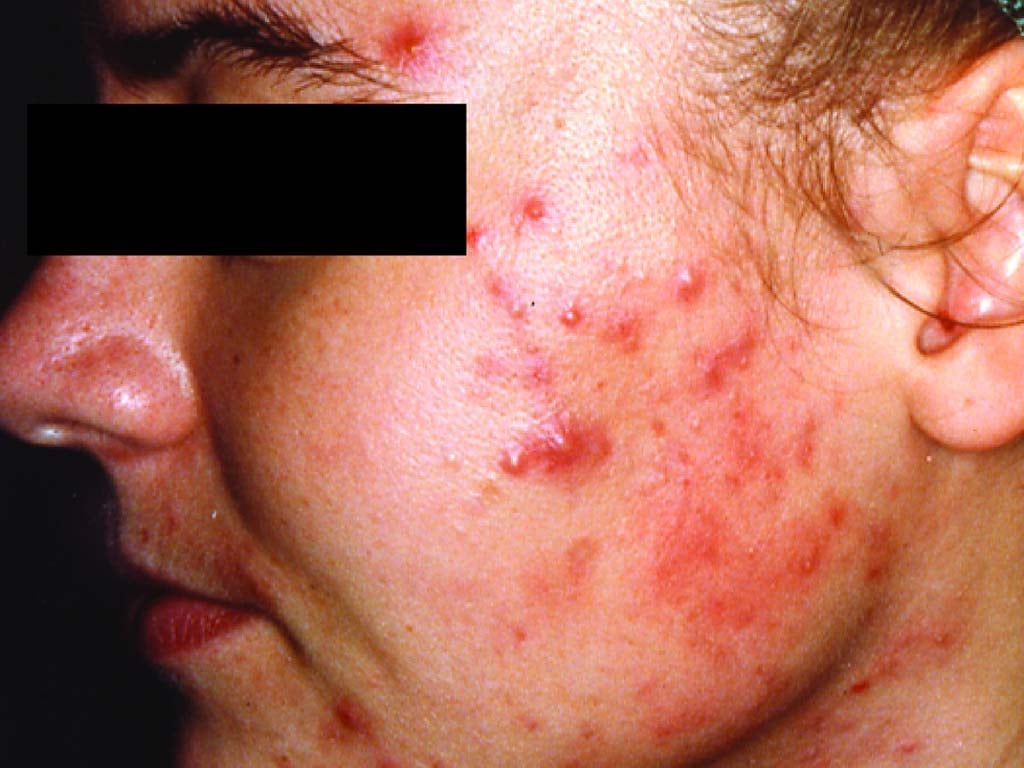 Esto es lo que el acné revela sobre tus problemas ocultos de salud. Conoce este mapa de la cara
