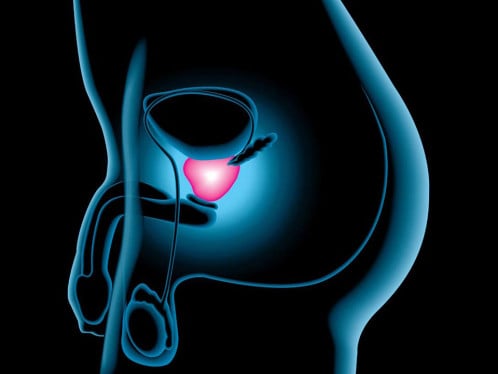 ¿Cáncer de próstata? 12 primeros síntomas que los hombres nunca deben ignorar