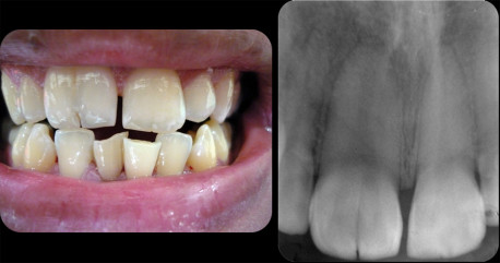 8 traumáticos hechos sobre tus dientes que te harán querer cepillarlos más