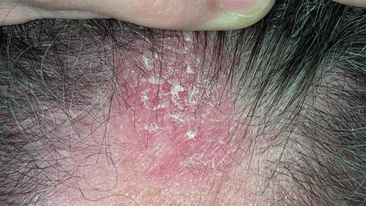 Cabelludo dermatitis caseros remedios cuero seborreica