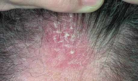 Conoce tratamientos naturales para eliminar la dermatitis seborreica