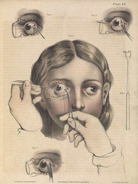 Así eran las cirugías sin anestesia entre los siglos XVII y XIX