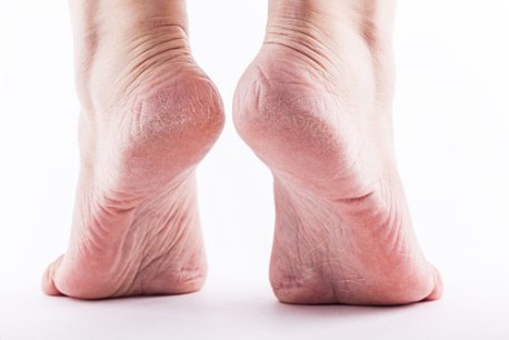 Cura los talones agrietados y los callos con este potente remedio casero