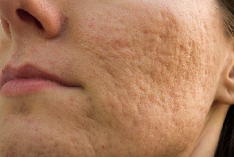 Así puedes eliminar las cicatrices causadas por el acné