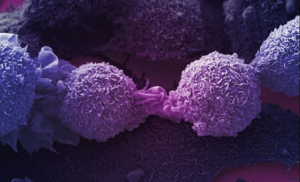 Nueva investigación revela el verdadero material que constituye a las células cancerosas