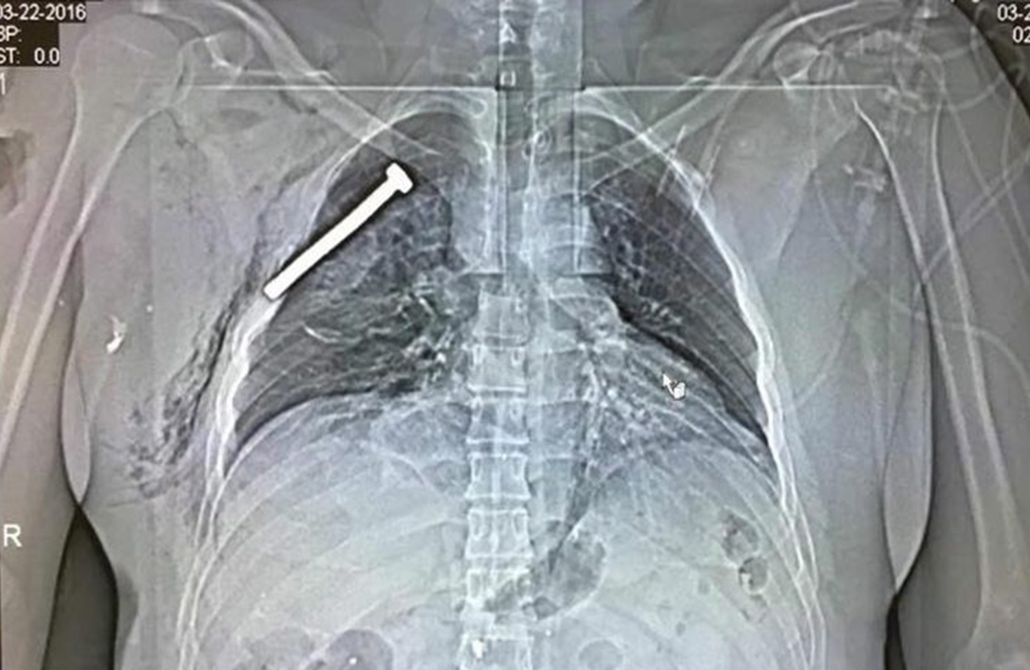 Rayos X revelan tornillo enterrado en el pecho de herido por bomba en Bruselas