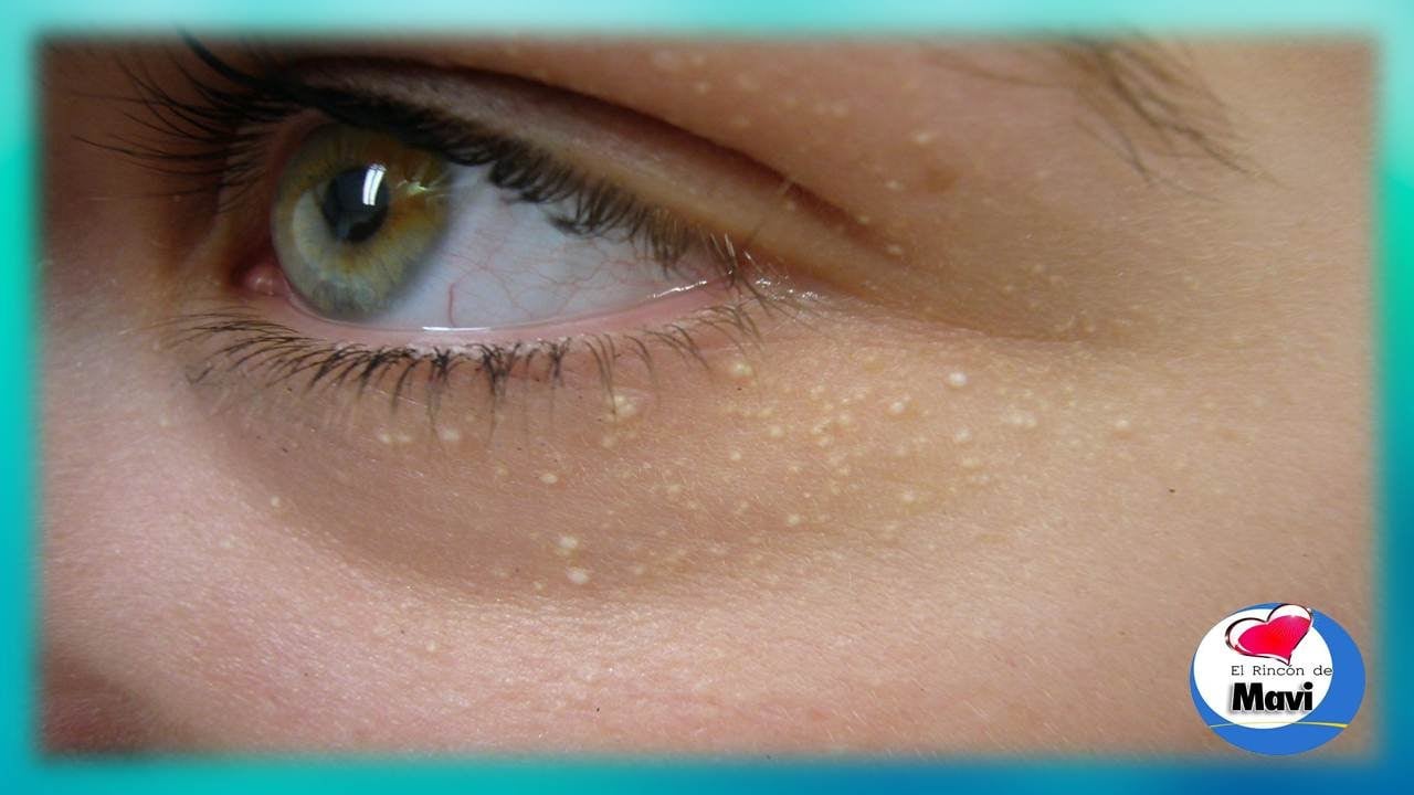 Elimina Los Milium Las Bolitas Blancas De La Cara Con Remedios Naturales