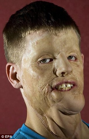 Mira la vida de este hombre tras 5 años de recibir un transplante de rostro