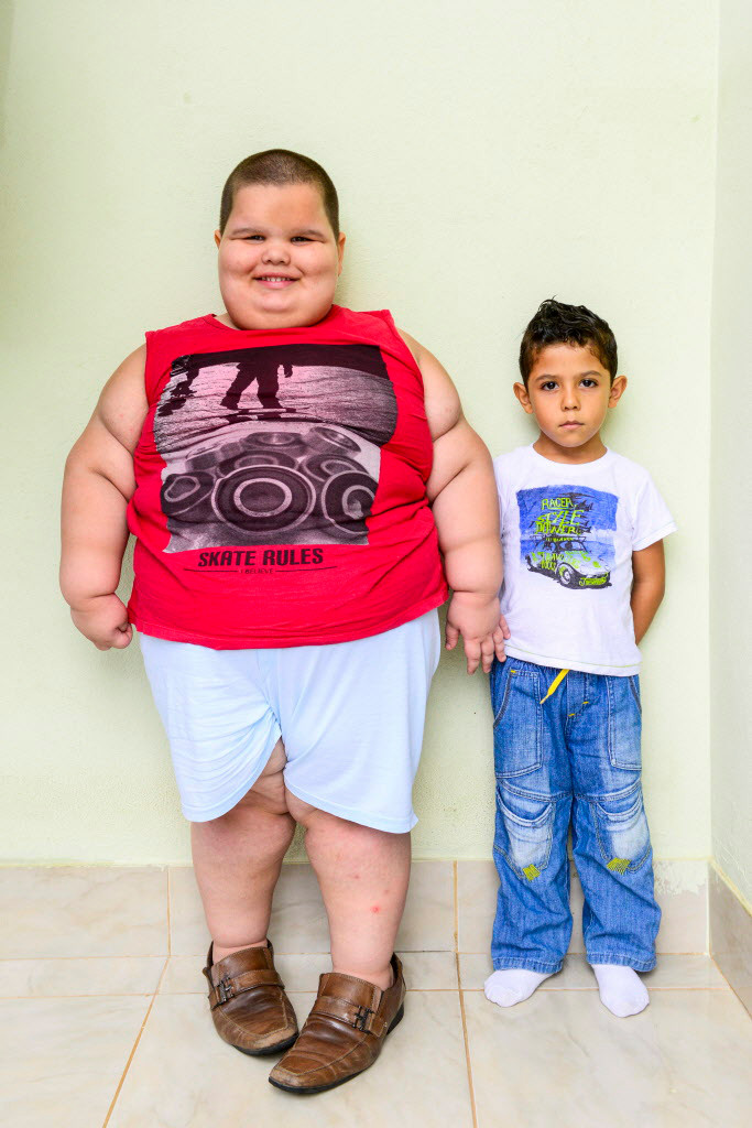 Niño obeso podría morir si no para de comer