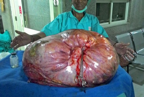 Un tumor de 97 kilos fue extraído de una mujer que lo soportó por 5 años