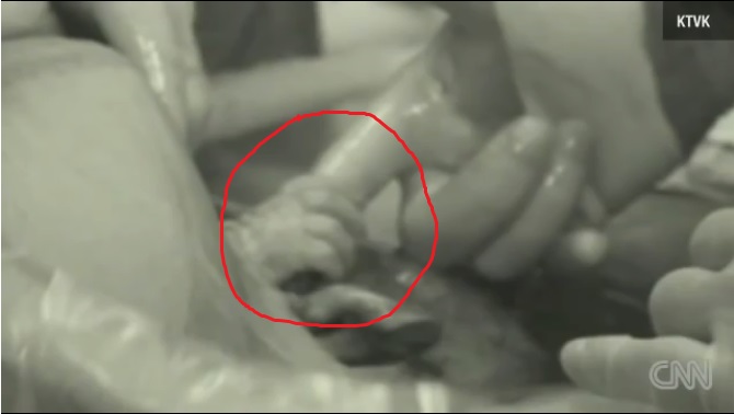 Bebé agarró el dedo de su matrón teniendo aún medio cuerpo en el útero