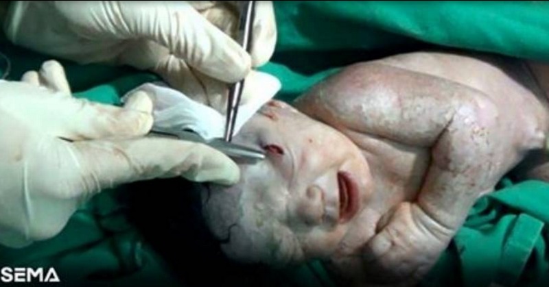 Bebe nació con una bala incrustada en el cráneo: la madre fue herida durante la gestación
