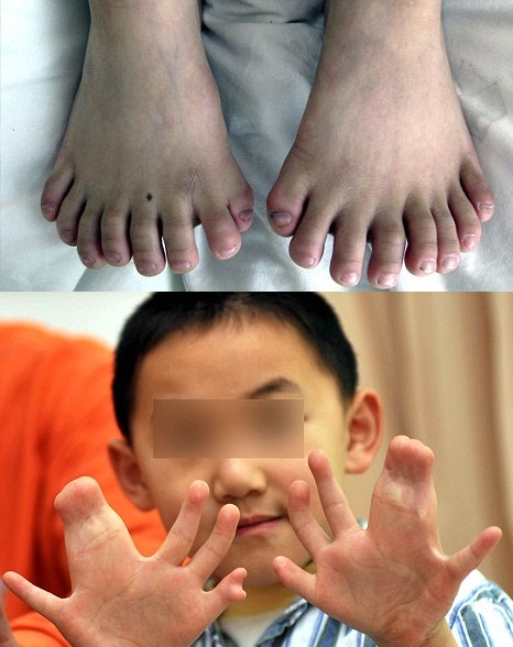 Niño chino tiene 31 dedos: 15 en las manos y 16 en los pies
