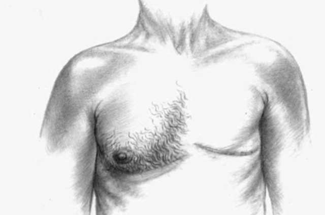 Cáncer mamario en hombres: una realidad poco conocida