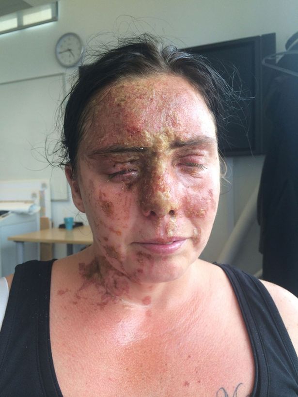 Despiadado sujeto roció ácido en la cara de una mujer y subió una foto de ella sufriendo a Facebook
