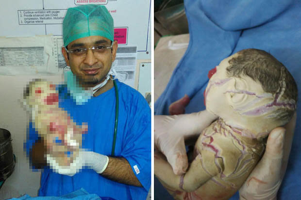 Primera bebé nacida sin nada de piel estremece al mundo