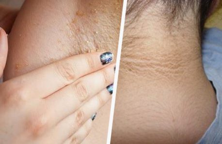 ¿Es posible blanquear las axilas y el cuello naturalmente?