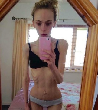 Madre desesperada publica fotos de su hija anoréxica para tratar de salvarle la vida