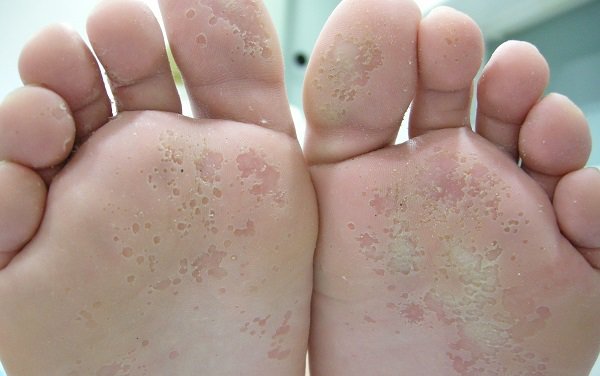Mira estas tres maneras naturales de acabar con los hongos de tus pies