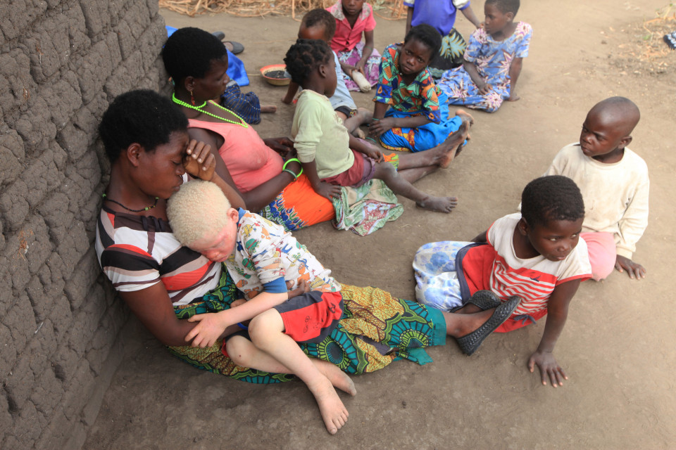 Albinos son raptados creyendo que sus huesos contienen oro y que el sexo con ellos curaría el SIDA