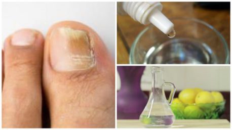 Fabrica tu propio “rompe hongos” natural para las uñas