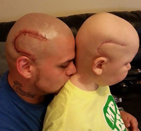 Padre se tatúa cicatriz en la cabeza para solidarizar con su hijo que tiene cáncer