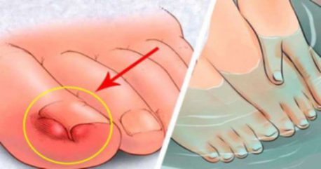 6 remedios caseros para aliviar las uñas encarnadas