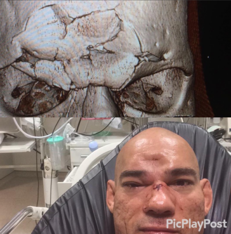 Michael Page le fracturó el cráneo a Evangelista Santos