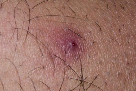 ¿Cómo tratar (y evitar) los vellos y pelos encarnados? Acá te contamos la respuesta
