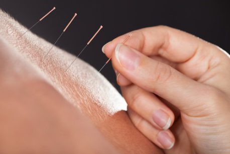 La acupuntura: Qué es y cuáles son sus beneficios