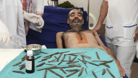 Este es el verdadero «traga sables»: le sacaron 40 cuchillos del estómago