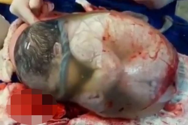 Insólito: bebé nació dentro de su saco amniótico y así luce este extraño fenómeno