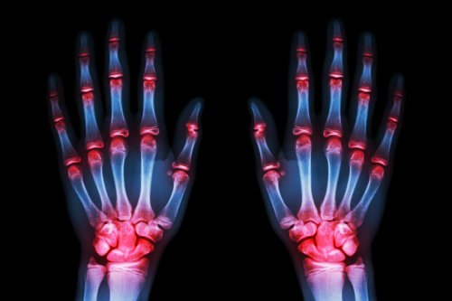 Según un estudio, en 5 o 10 años habrá tratamiento para “frenar” la artrosis