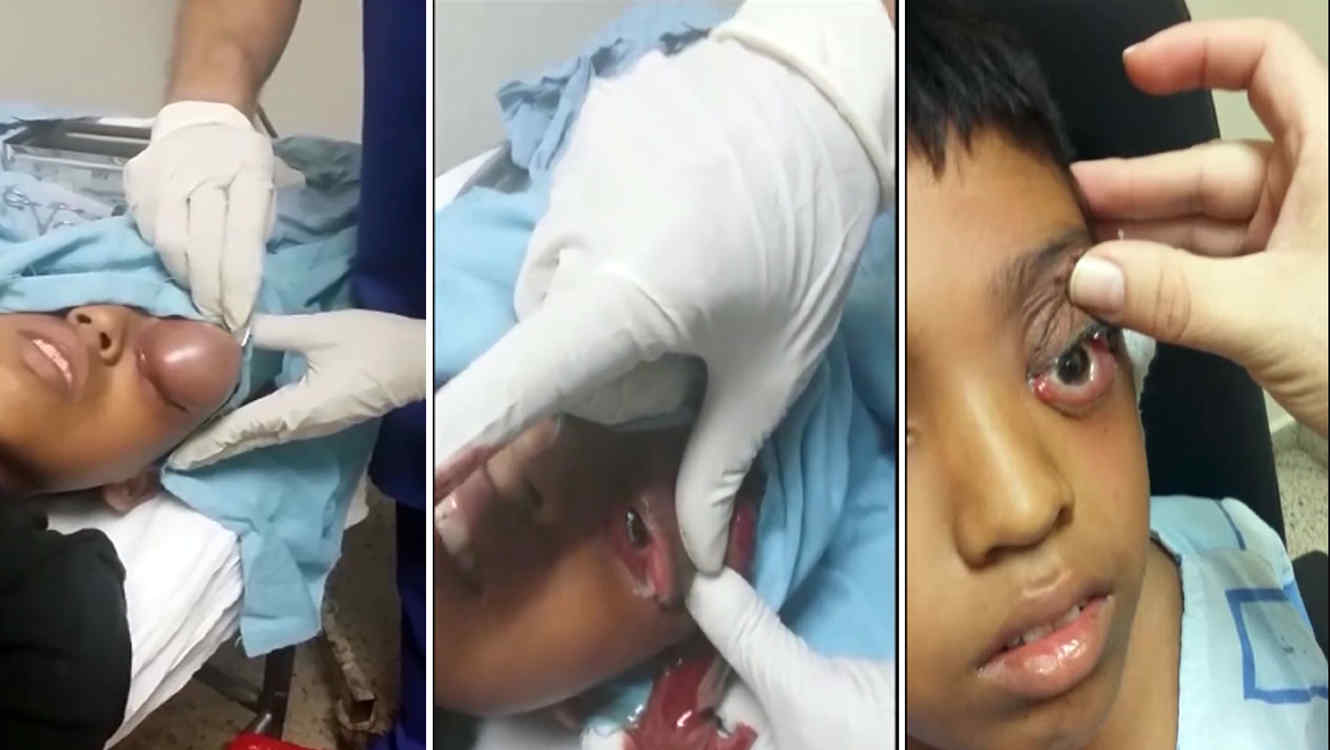 (Video) Médico explota un enorme bulto en el ojo de un niño